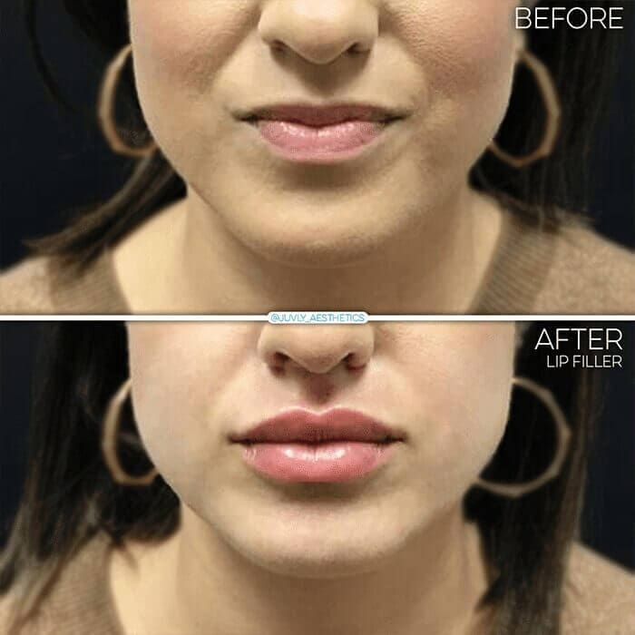 lip-filler-woman