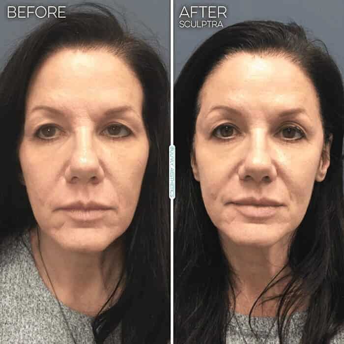 collagen-stimulator-sculptra-1 (1)