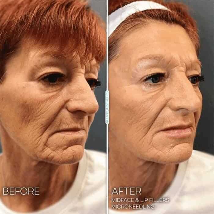 face-collagen-stimulator