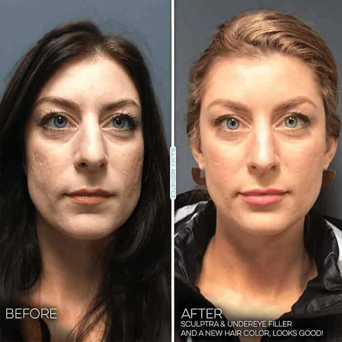 sculptra-collagen