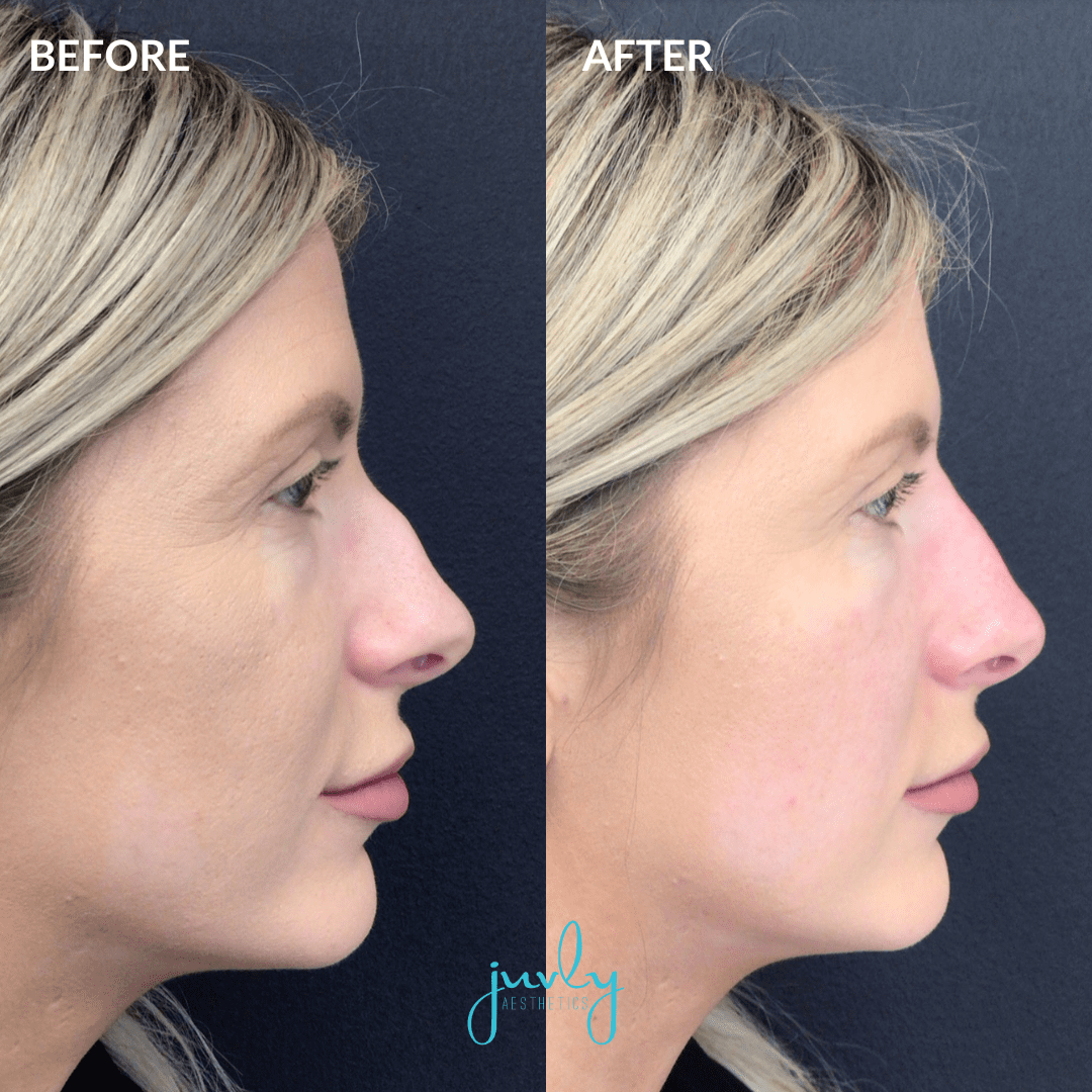 Liquid nose job near me