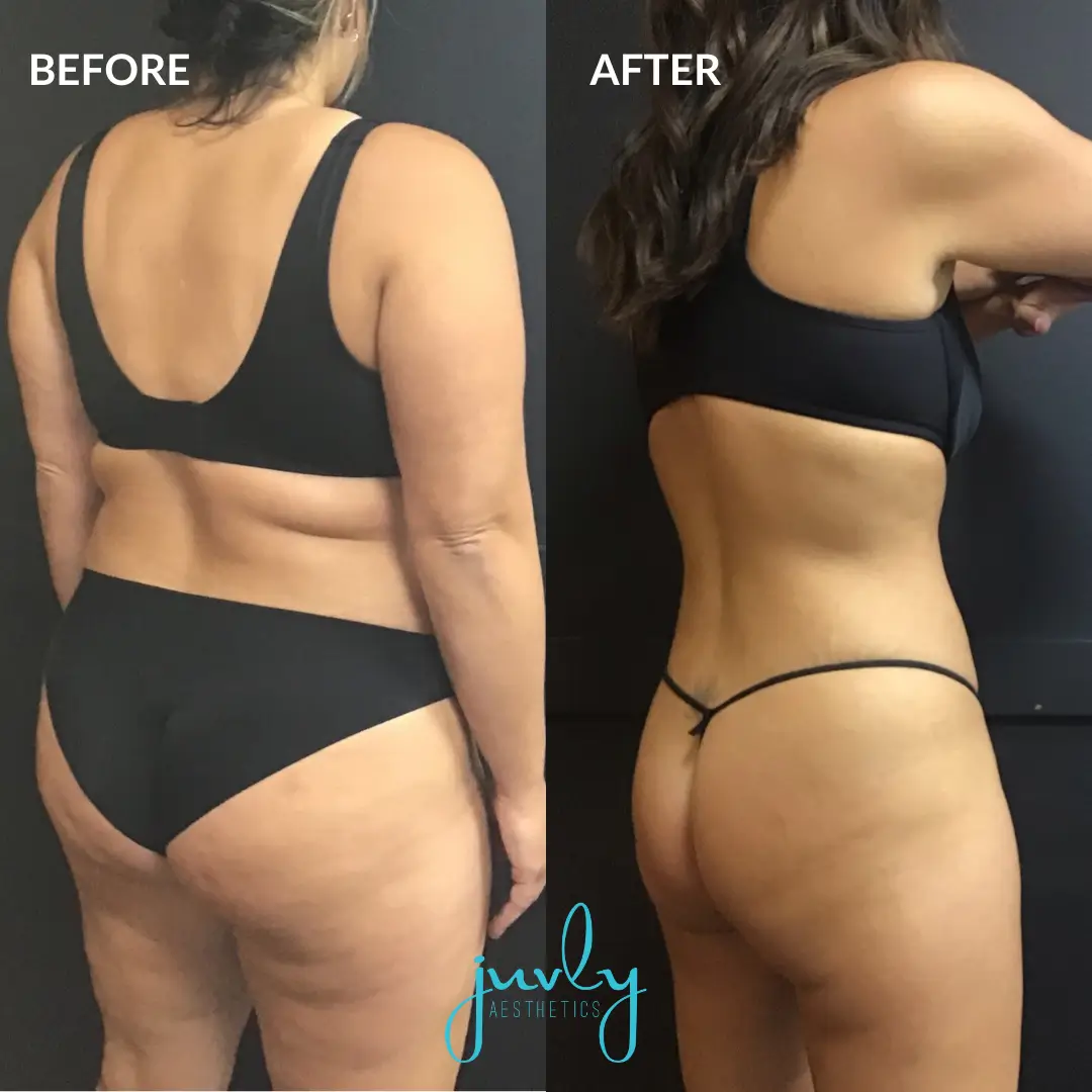 Semaglutide before after