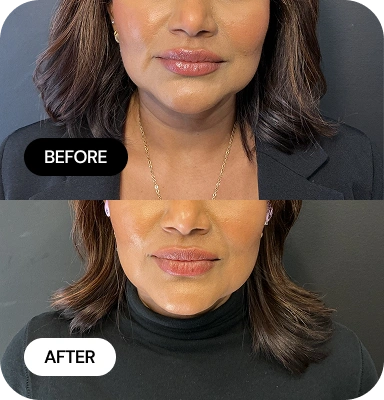 Targeted Lift & Contour before and after