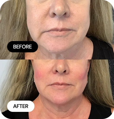 Targeted Lift & Contour before and after