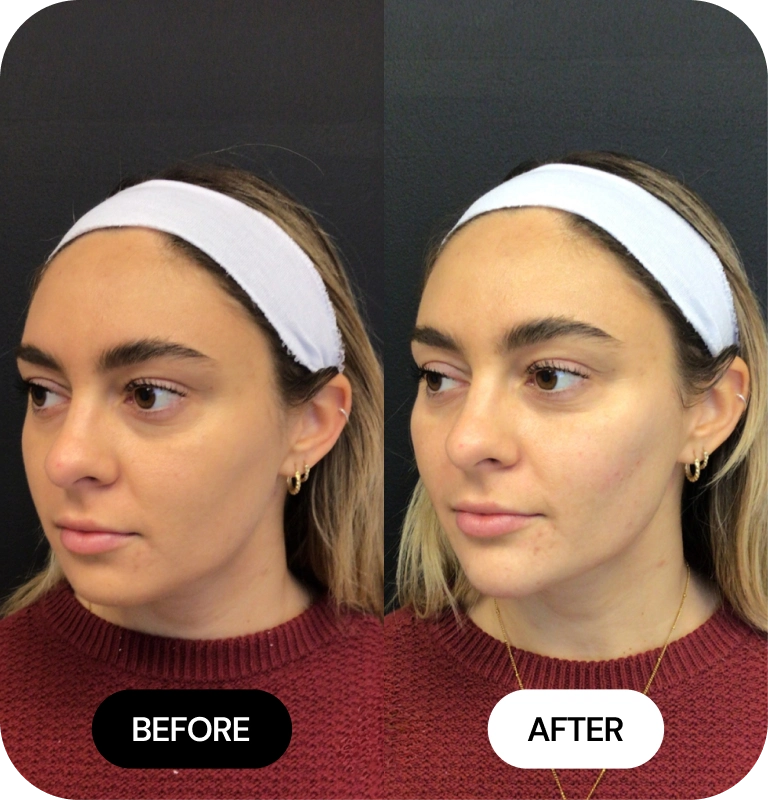 Cheek Filler before and after