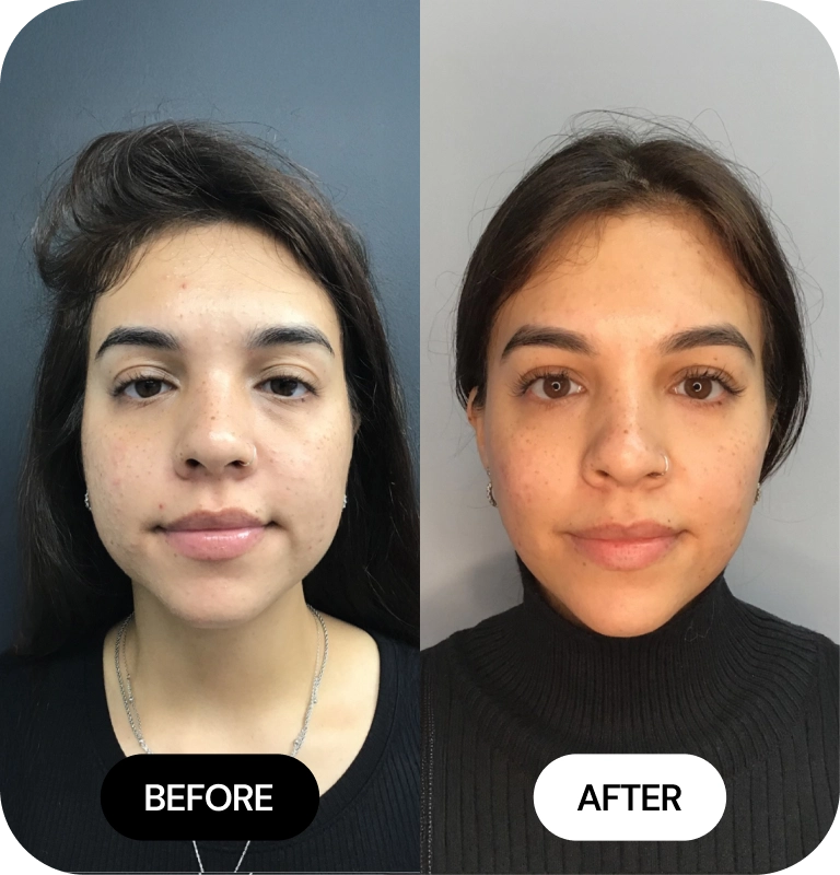 Cheek Filler before and after