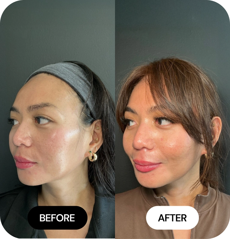 Cheek Filler before and after