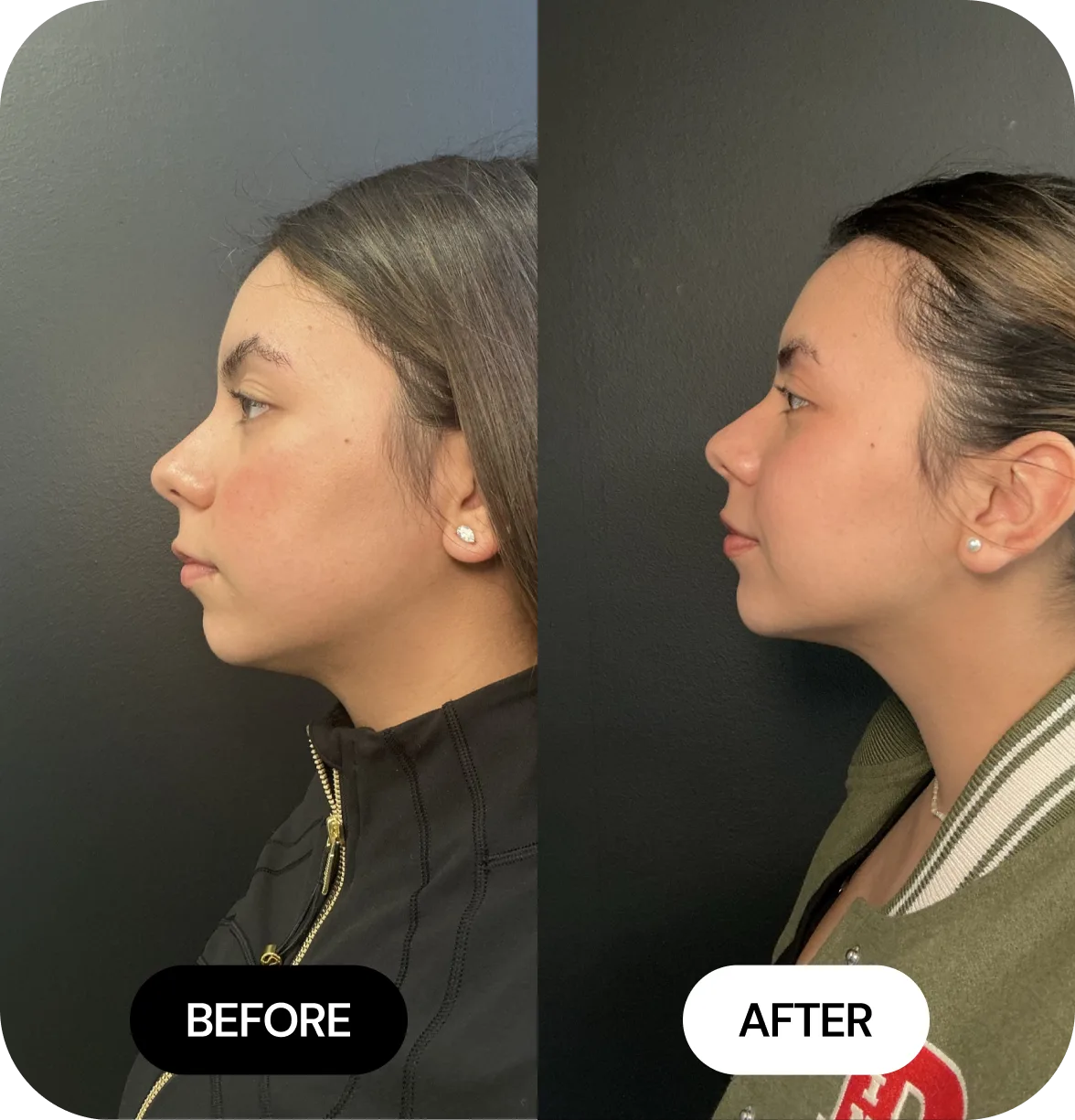 Chin Filler before and after