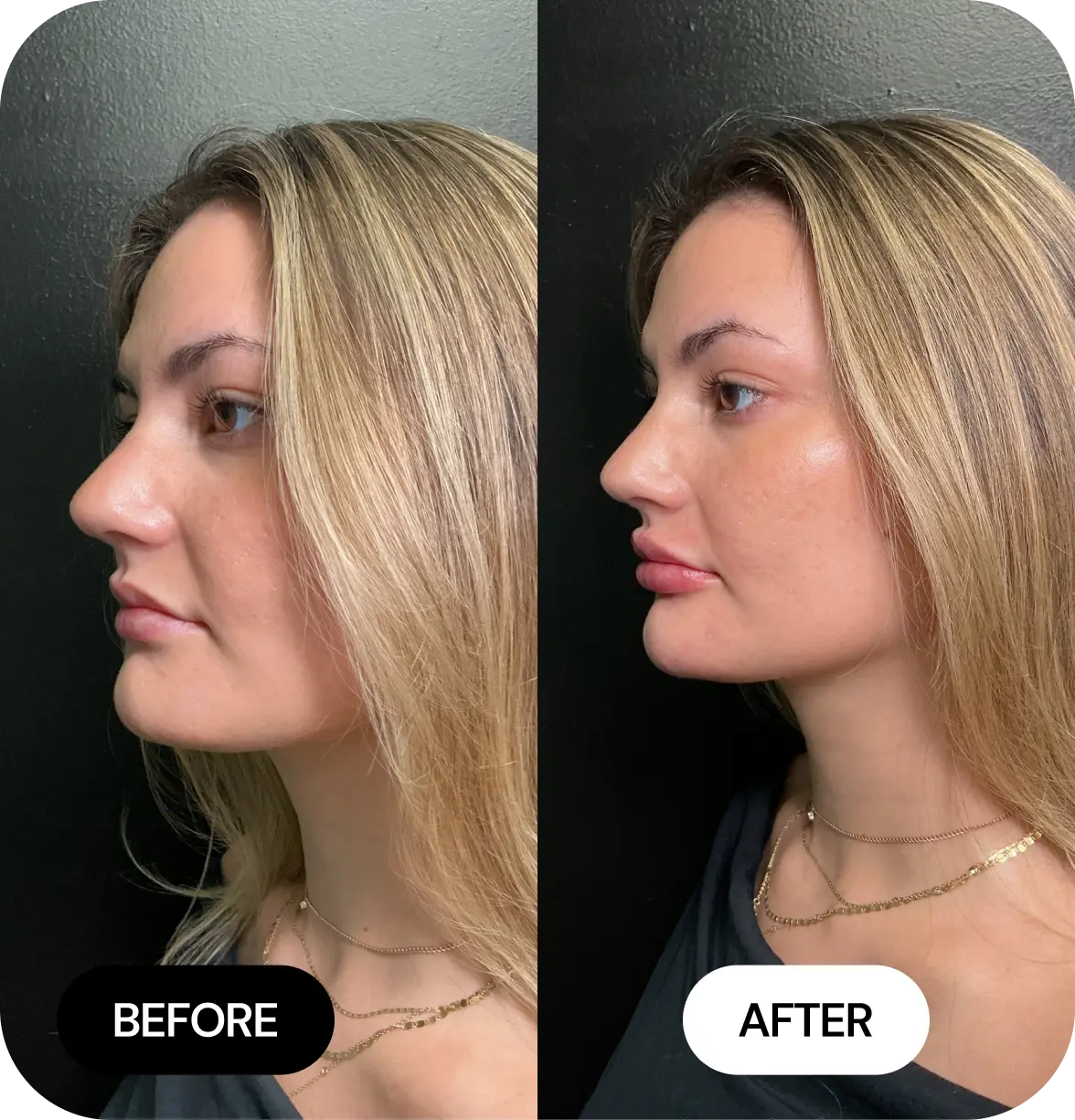 Chin Filler before and after