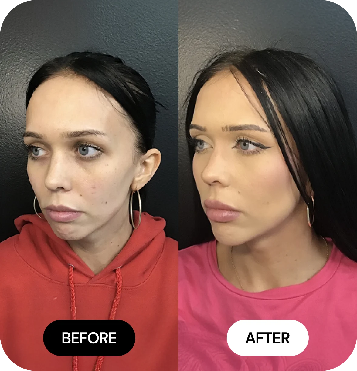 Chin Filler before and after