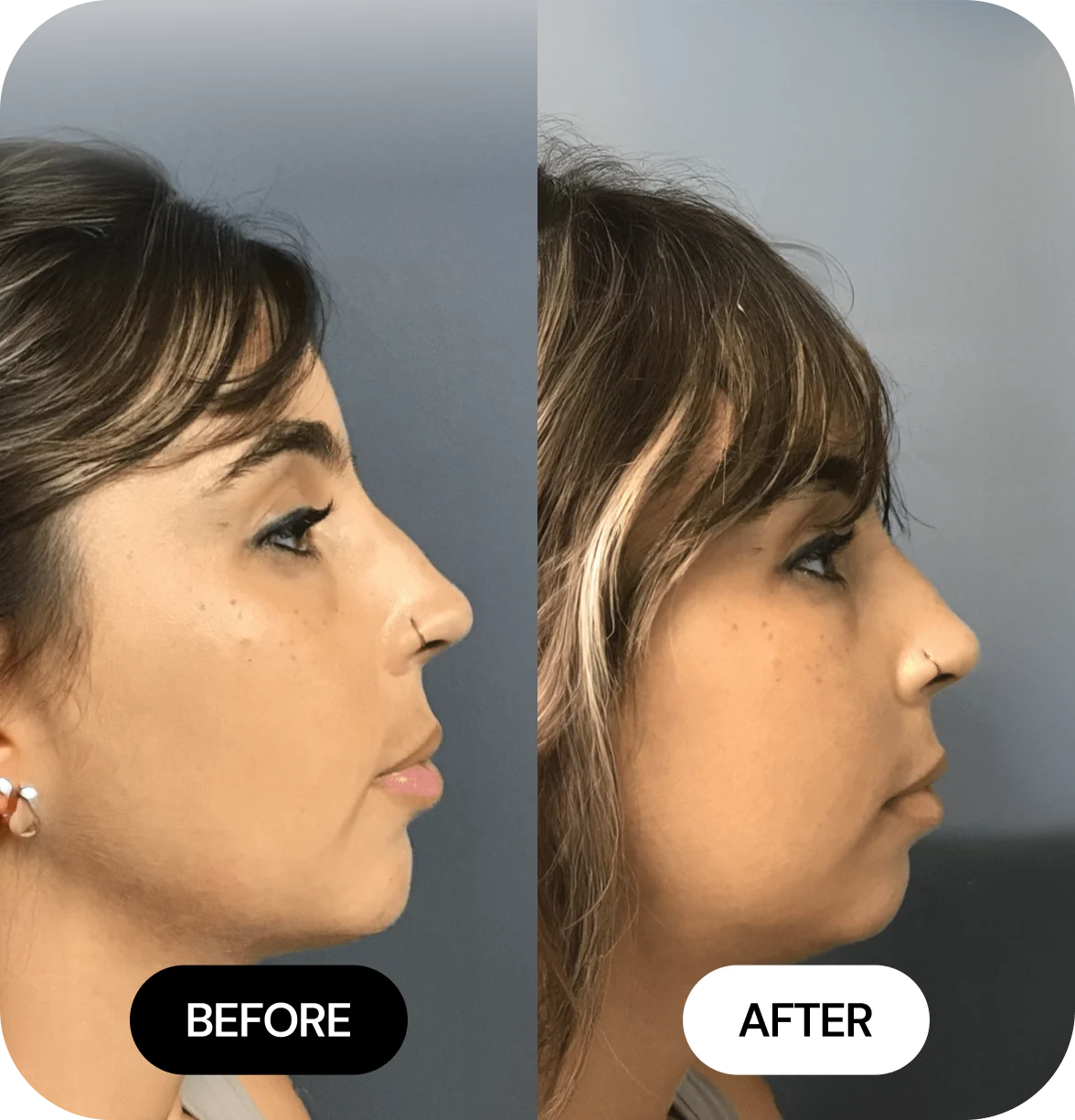 Chin Filler before and after