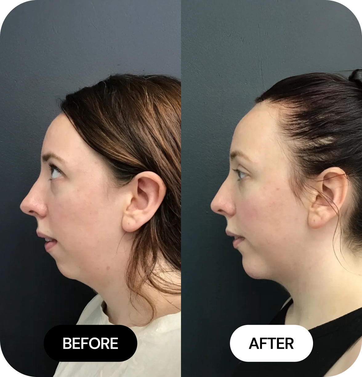 Chin Filler before and after