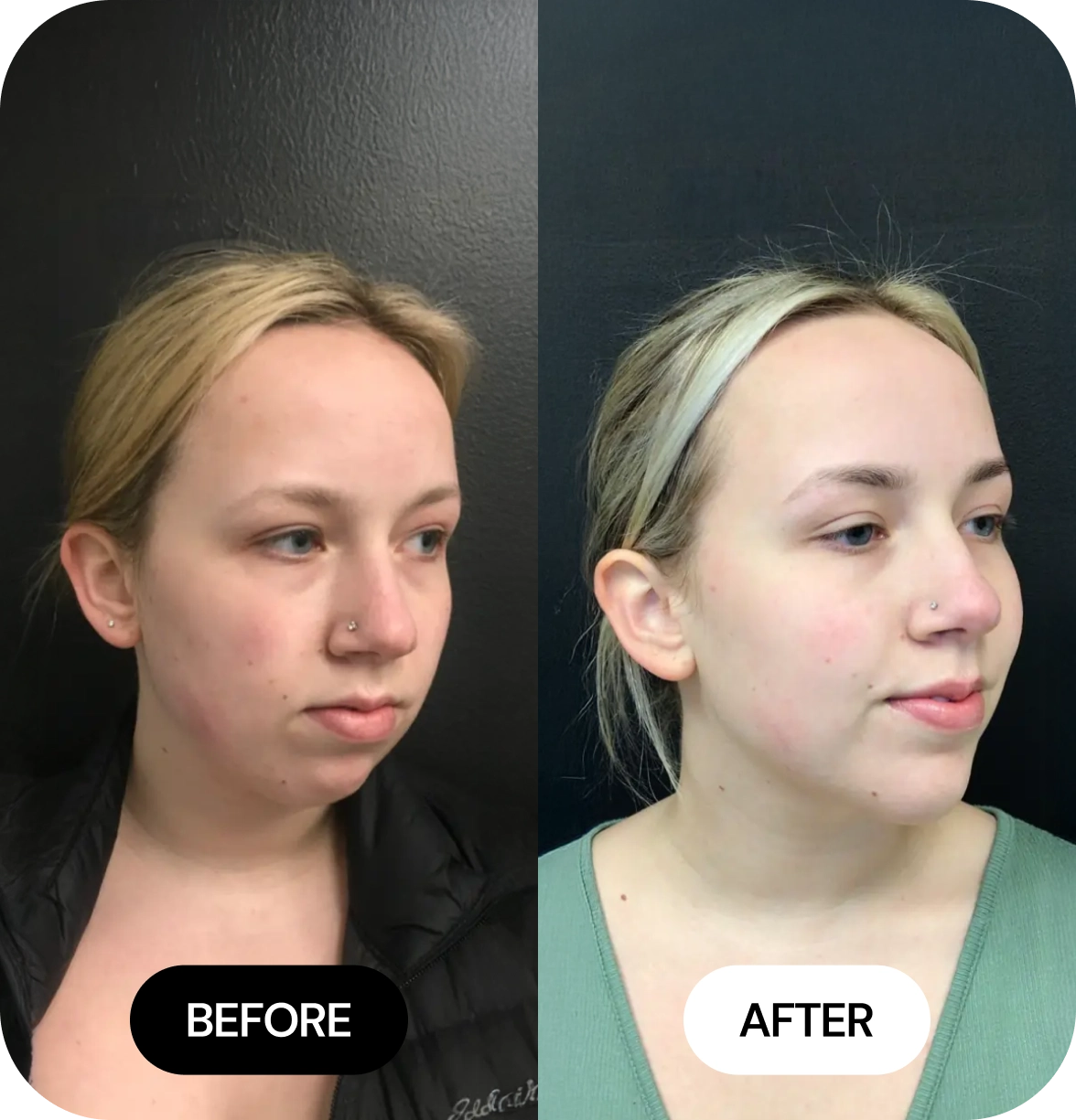 Chin Filler before and after