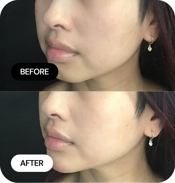 Chin Filler before and after