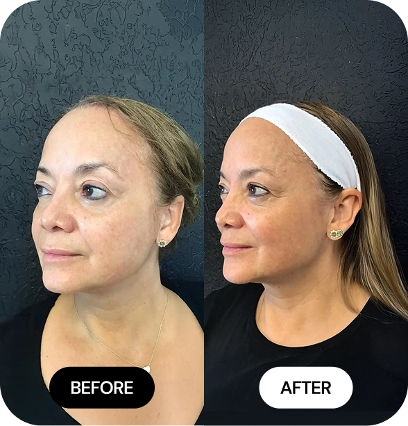 Chin Filler before and after