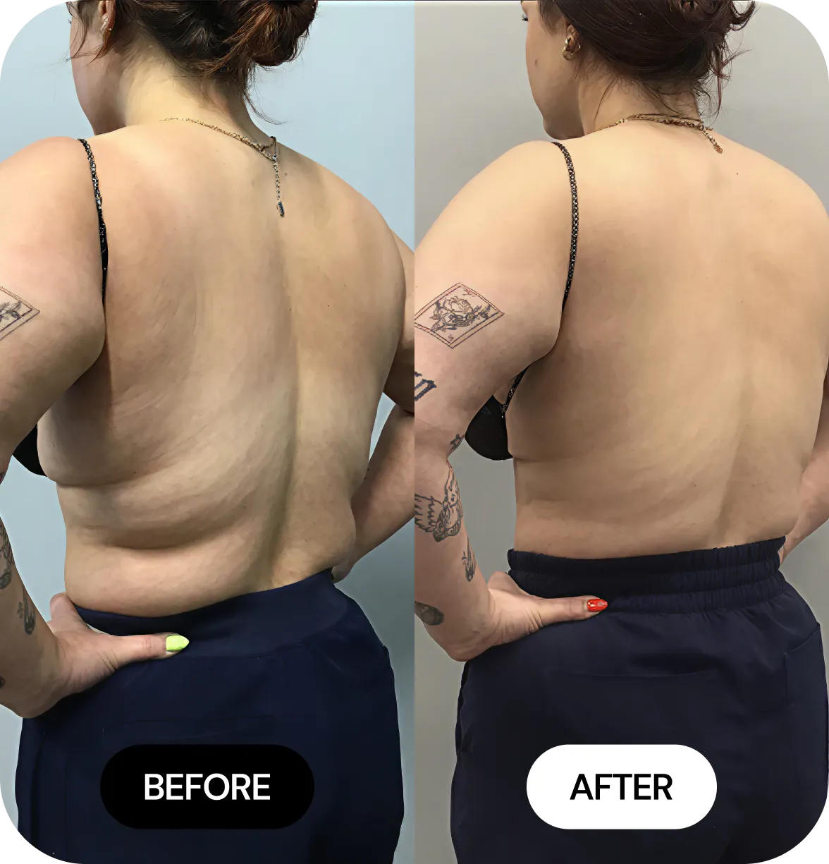 CoolSculpting before and after