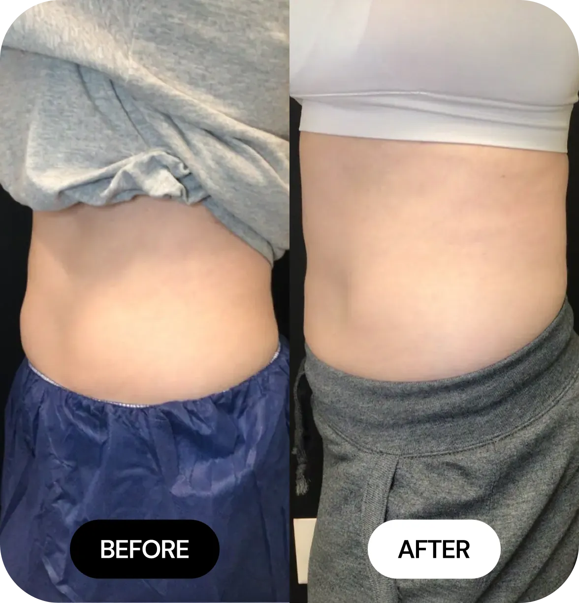 CoolSculpting before and after