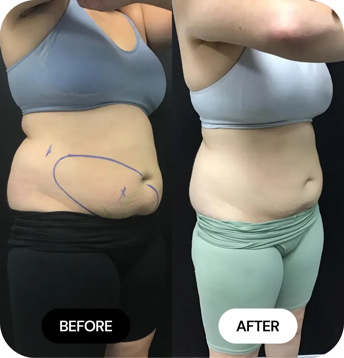 CoolSculpting before and after