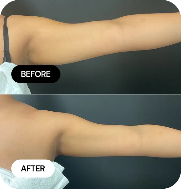 CoolSculpting before and after