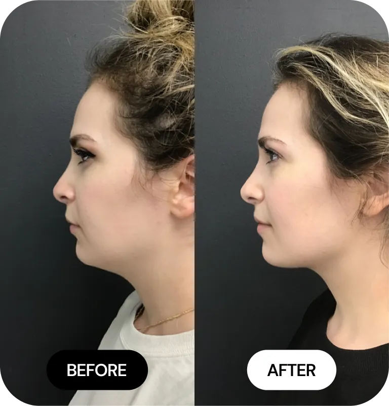 Kybella Fat Reduction before and after