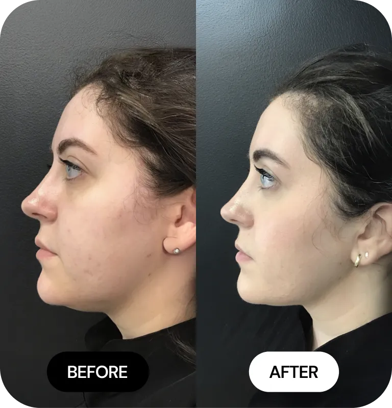 Kybella Fat Reduction before and after