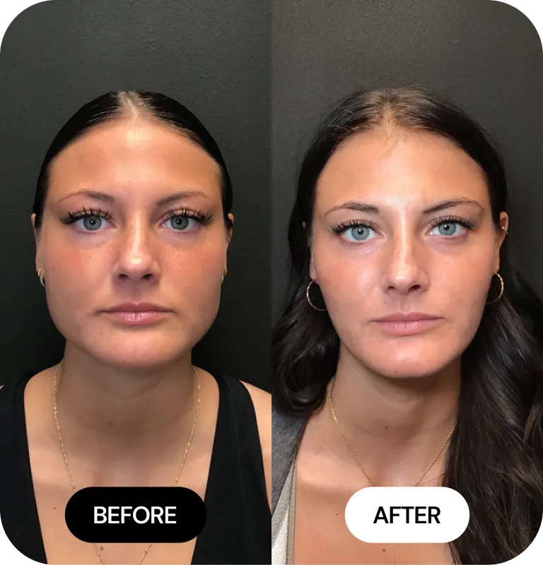 Facial Slimming before and after