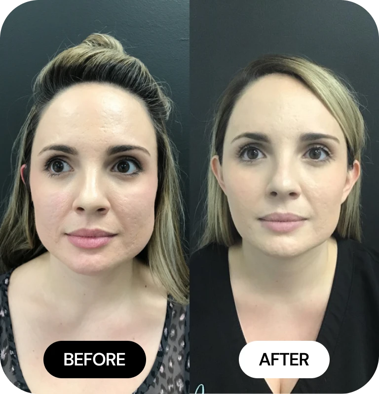 Facial Slimming before and after