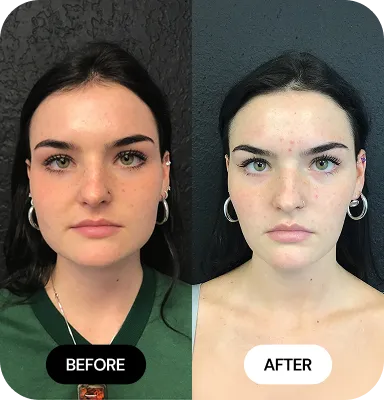 Facial Slimming before and after
