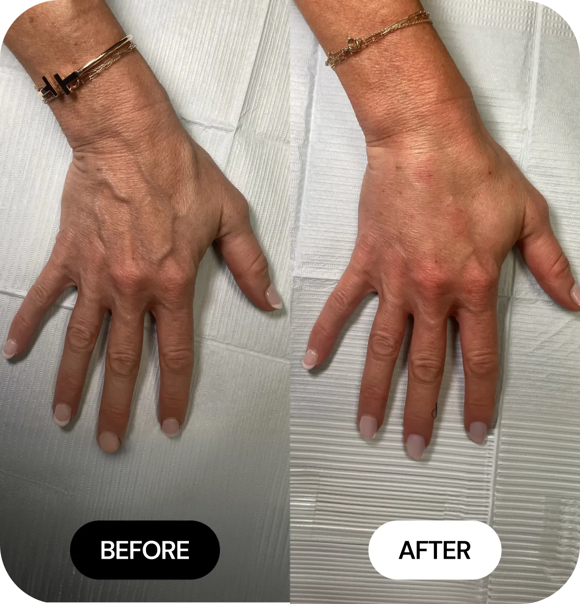 Hand Filler before and after