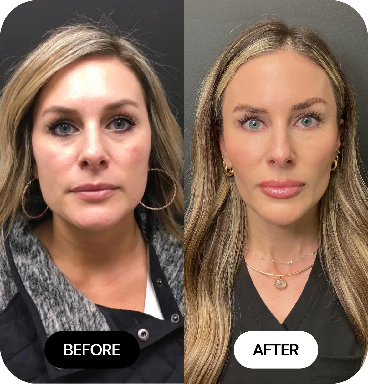 JLYFT before and after