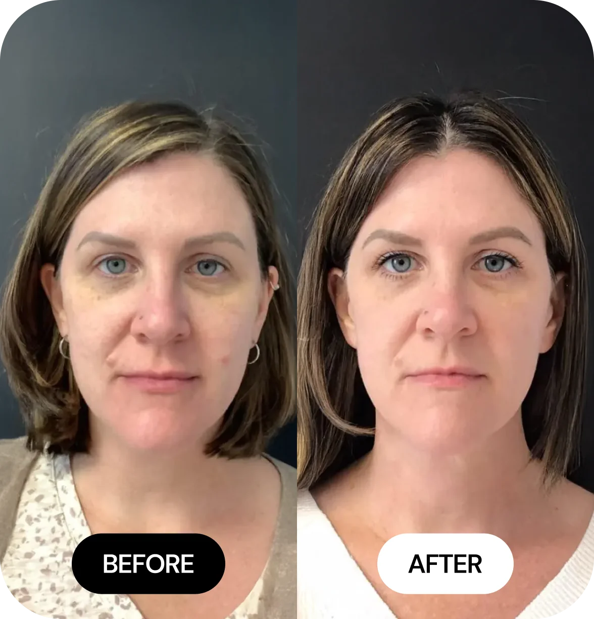 JLYFT before and after