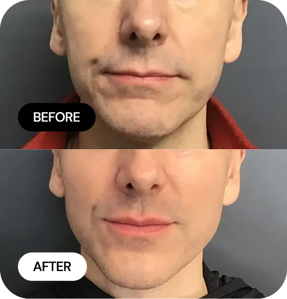 JLYFT before and after