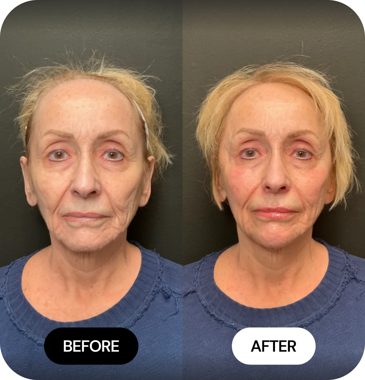JLYFT before and after