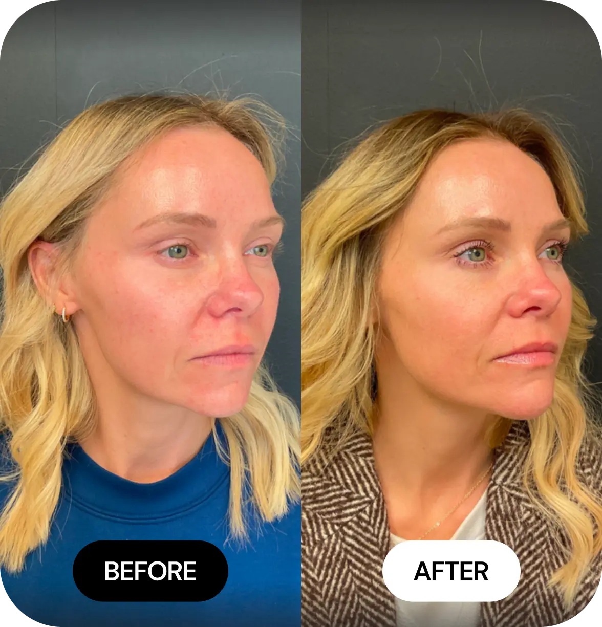 JLYFT before and after