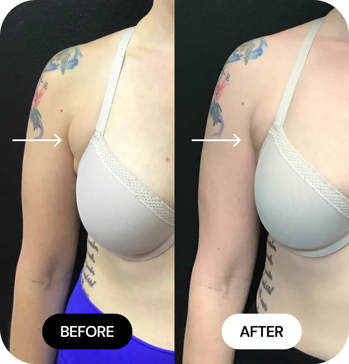 Kybella Fat Reduction before and after
