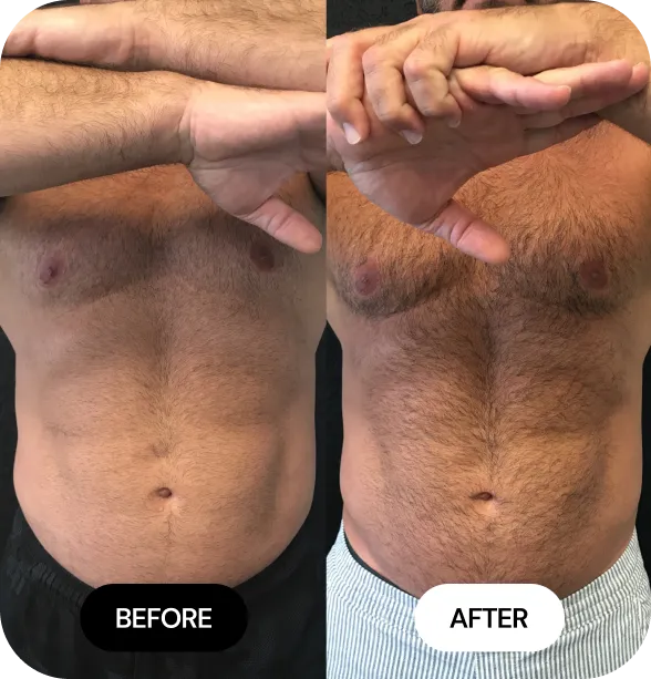 Kybella Fat Reduction before and after