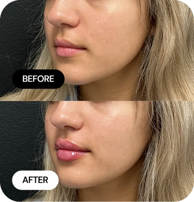 Lip Filler before and after