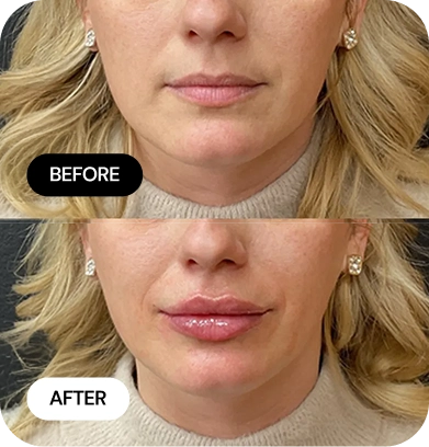 Lip Filler before and after