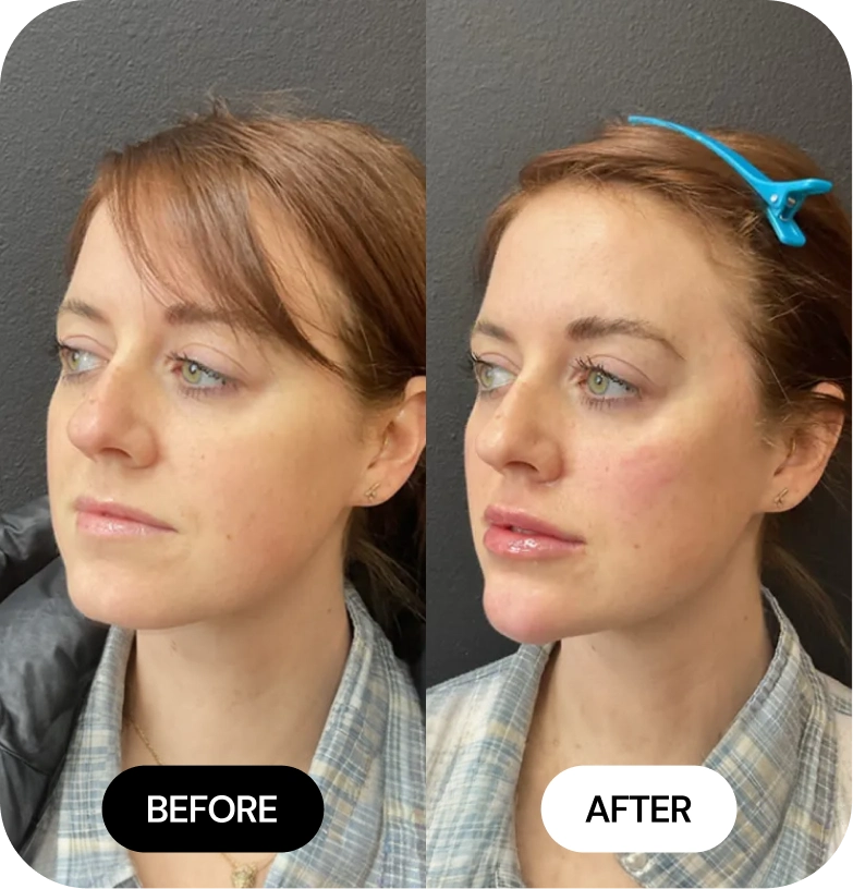 Lip Filler before and after