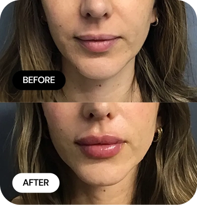 Lip Filler before and after