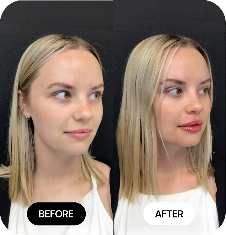 Lip Filler before and after