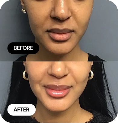 Lip Filler before and after