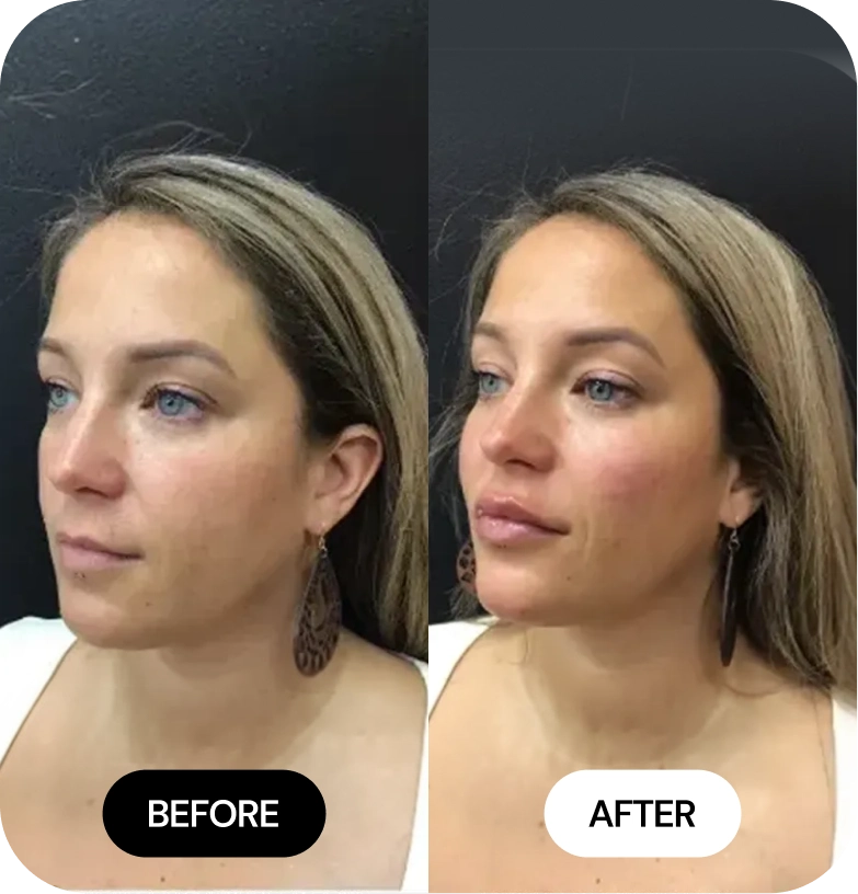 Lip Filler before and after