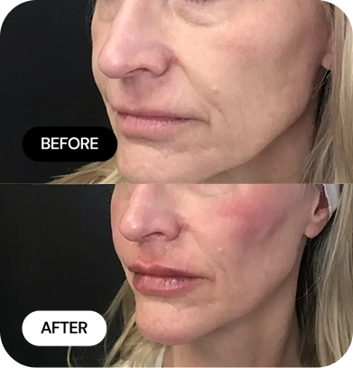 Lip Filler before and after