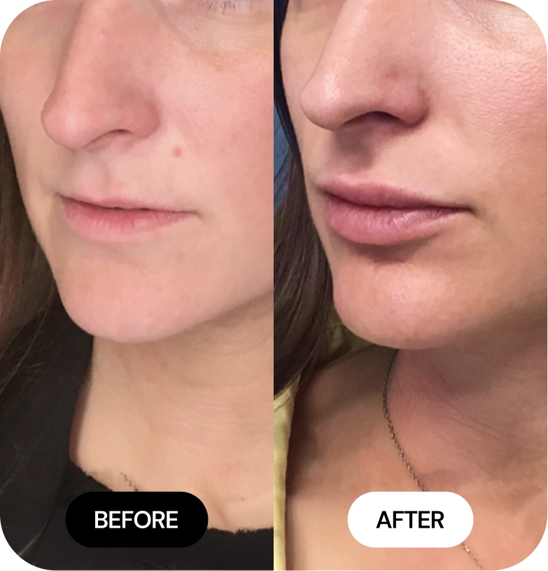 Lip Filler before and after