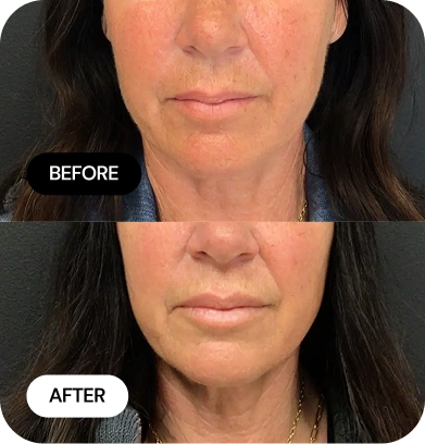 Lip Filler before and after