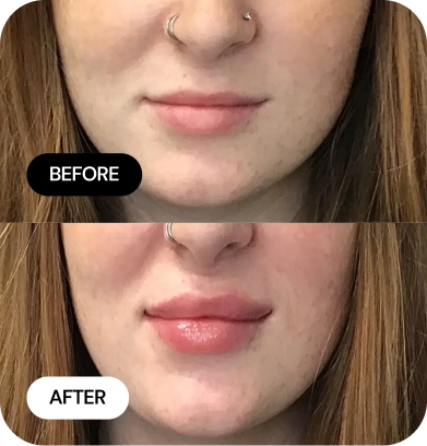Lip Filler before and after