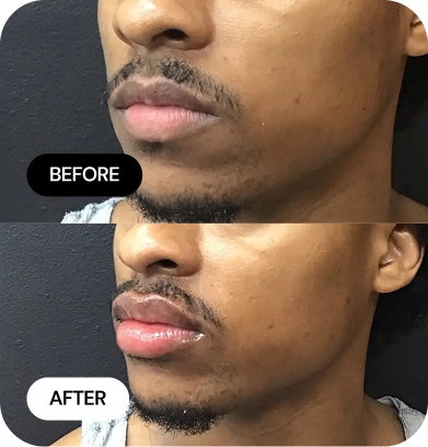 Lip Filler before and after