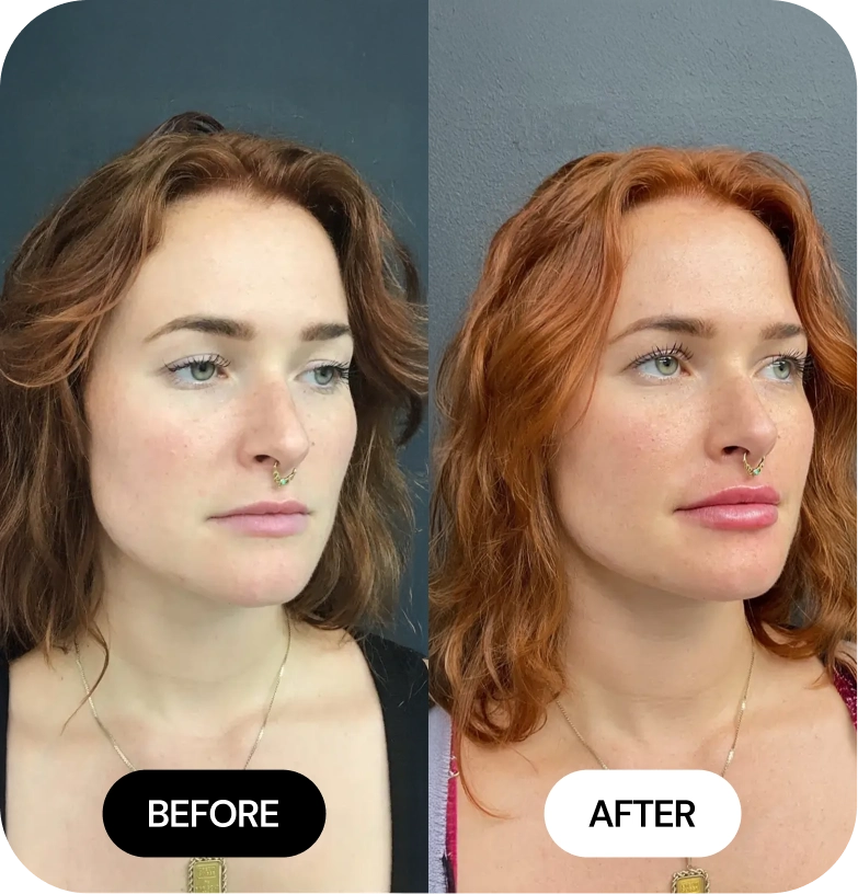 Lip Filler before and after