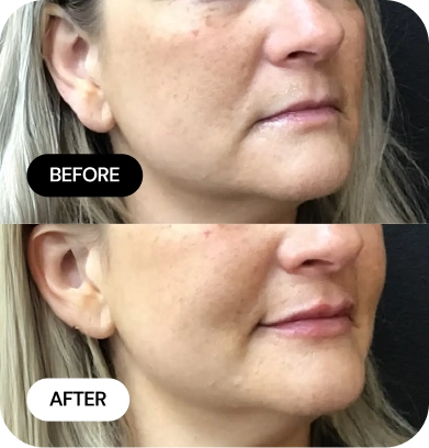 Lip Filler before and after